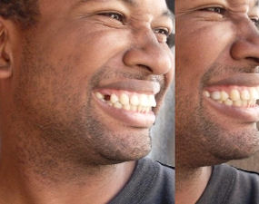 Replace a missing tooth - temporary tooth replacement you make